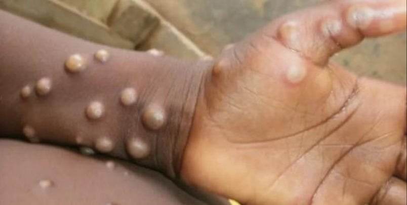 Ministerio de Salud Pública notifica dos nuevos casos de Viruela Símica en el país